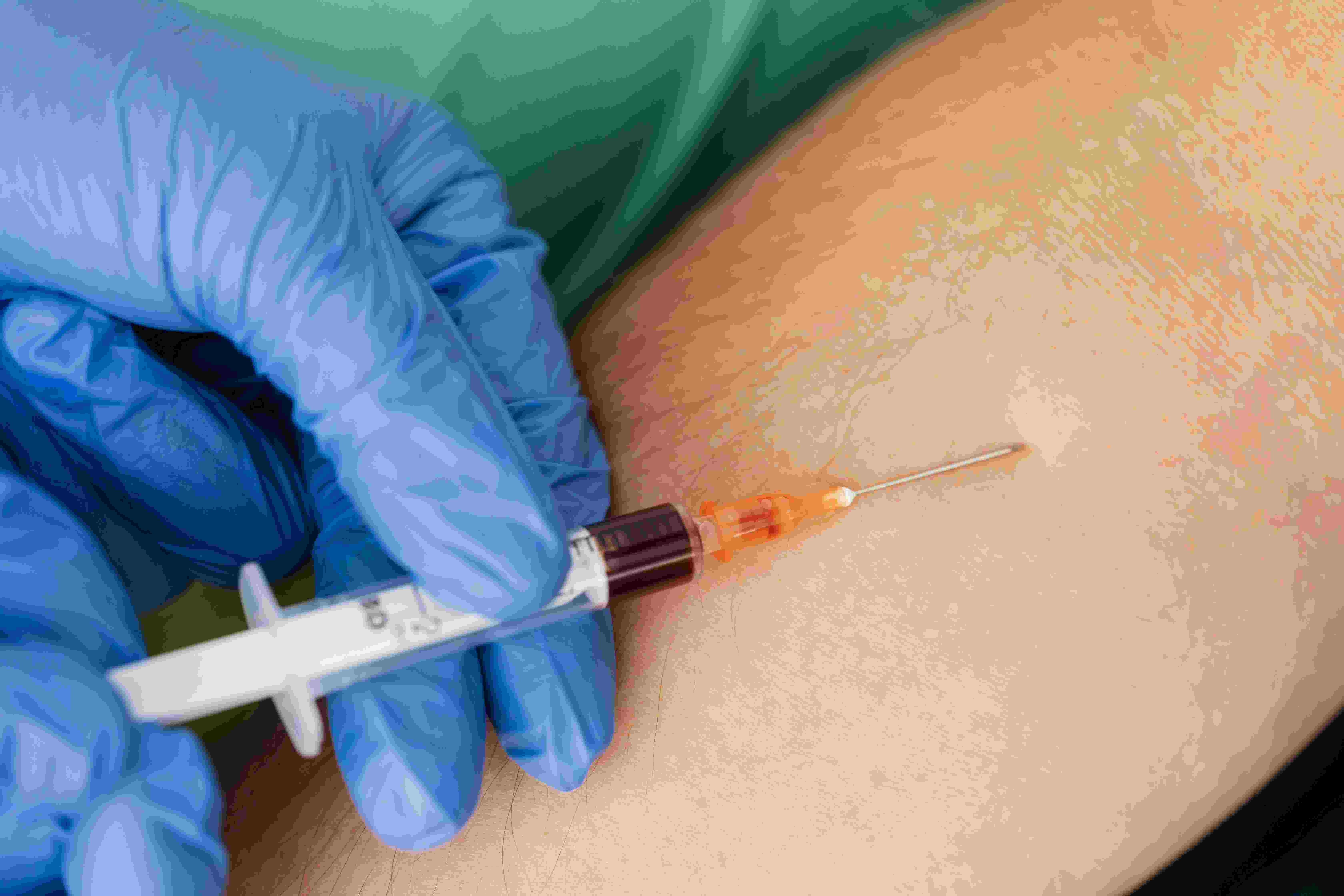Hyperlipidemia Management